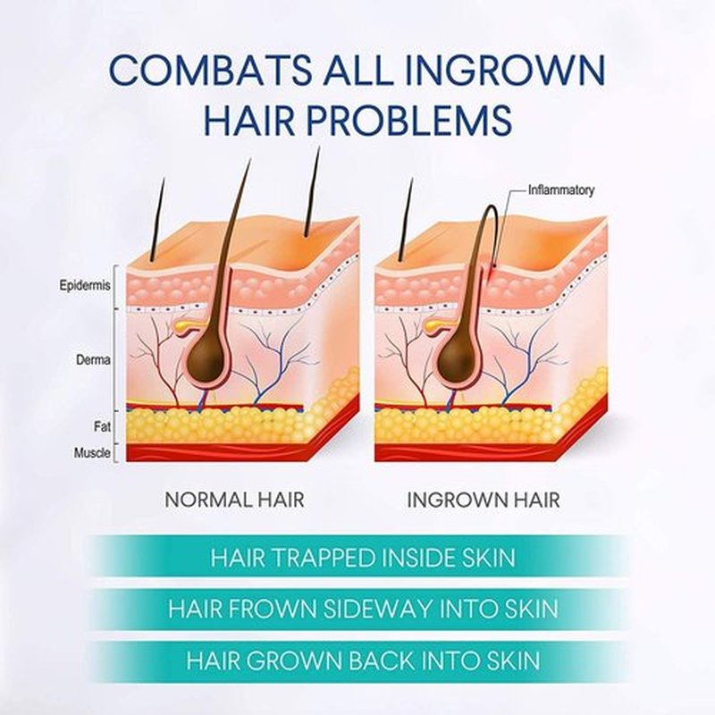 Razor Bumps Treatment for Women and Men, Ingrown Hair Treatment, Razor Bump Treatment for Bikini Area, Face, Neck, Legs, and Underarm Area, After Shave for Women and Men, Ingrown Hair Serum