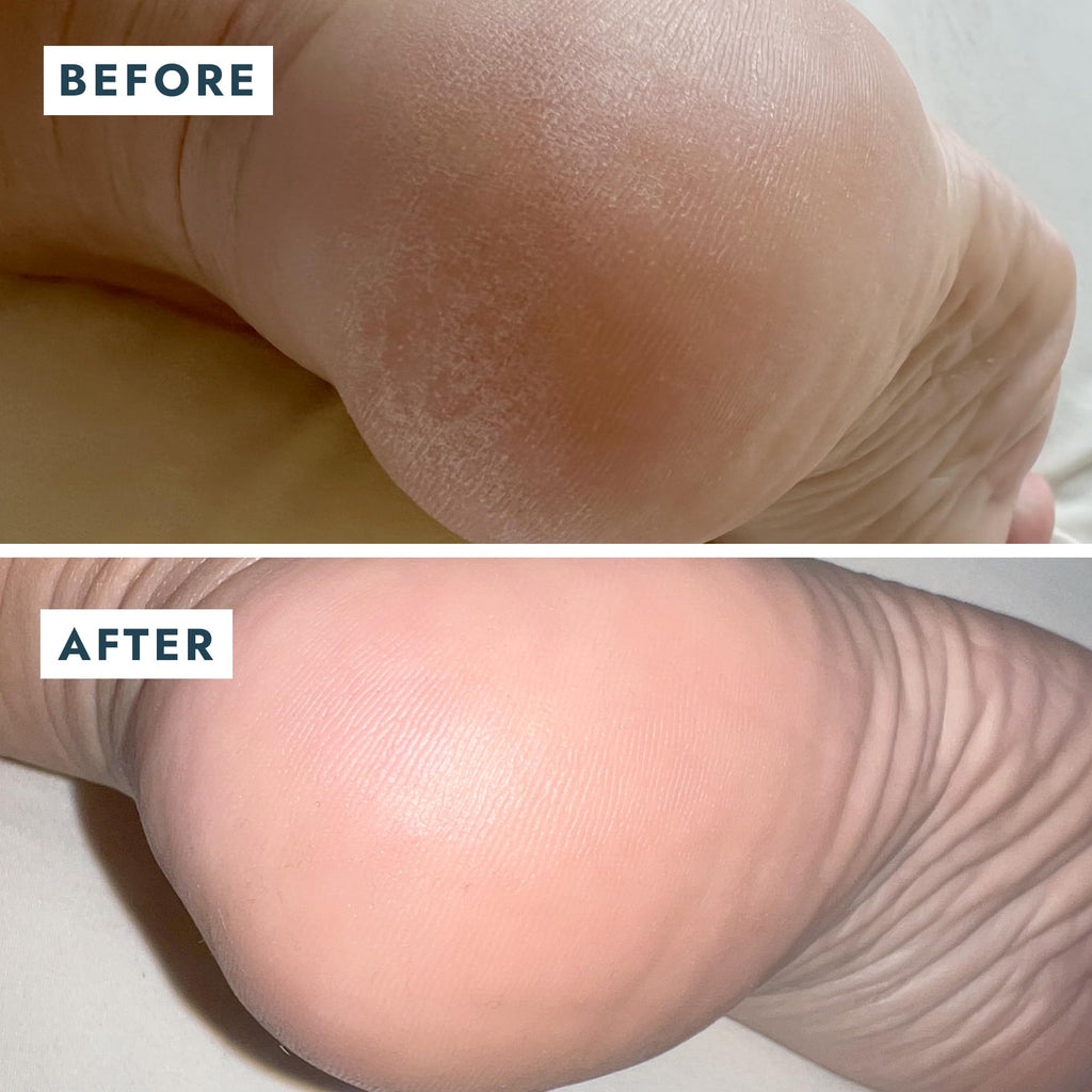 VOESH Solemate Heel Repair Balm, Heel Moisturizer & Repair, Balm for Rough and Cracked Heels, Foot Care