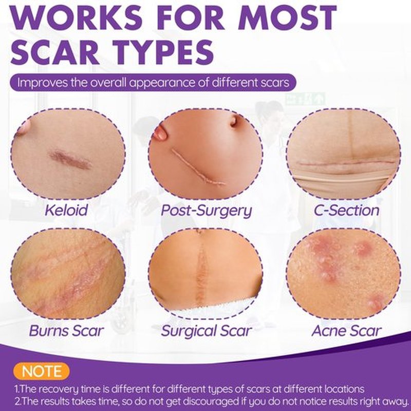Silicone Scar Sheets, Silicone Scar Tape(1.6"x 79" Roll-2M), Reusable Professional Scar Silicone Strips, Soft Silicone Scar Sheets for Surgical Scars,Keloid,Acne Scars,Burn Scar,C-Section