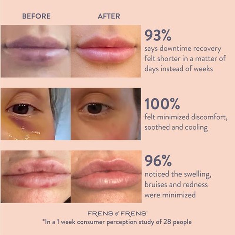 Frens of Frens Aesthetic Aftercare | TAKE After CARE Arnica & Bromelain Gel for Bruising, Swelling after Fillers, Cosmetic Injections | Cooling Depuff Serum Face Roller | 100% Vegan (30ml)