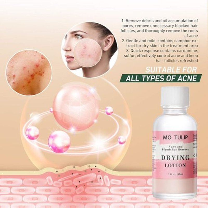 MO TULIP Acne Drying Lotion - Overnight Spot Treatment for Face & Body | 1 OZ Pimple Solution