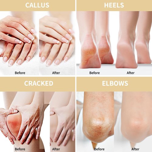 Grocerism Urea Cream 50 Percent for Feet 5.29 oz with Oat and 2% Salicylic Acid, Foot & Hand Cream included Hyaluronic Acid, Tea Tree and Aloe Vera for Deep Moisturizing, Callus Removing 2 Packs