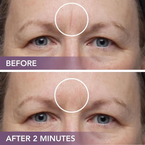 Dermaflage Scar Filler Kit - Waterproof Concealer for Deep Scars | Bronze Dark, 1 Month Supply