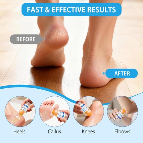 Silicone Moisturizing Socks with 60% Urea Cream- 2 in 1 Gel Socks & Urea Foot Cream for Dry Feet, Foot Care Moisturizing Socks for Dry Cracked Feet Women
