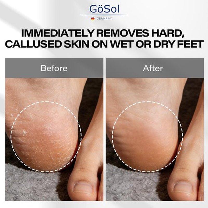 GöSol Foot Callus Remover Set, Durable Foot File and Foot Scrubber with 10Pcs Replacement Slices Blades, Callus Remover for Feet Callus Shaver Hard Dead Skin Pedicure Tools
