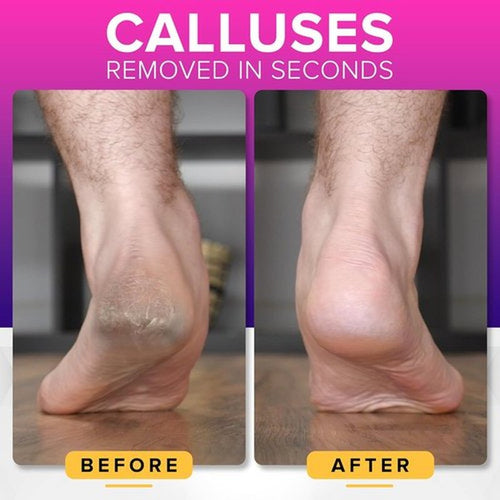 **NYK1 Megafile Foot Callus Remover - Rustproof XL Size with Skin Catcher for Wet & Dry Use**