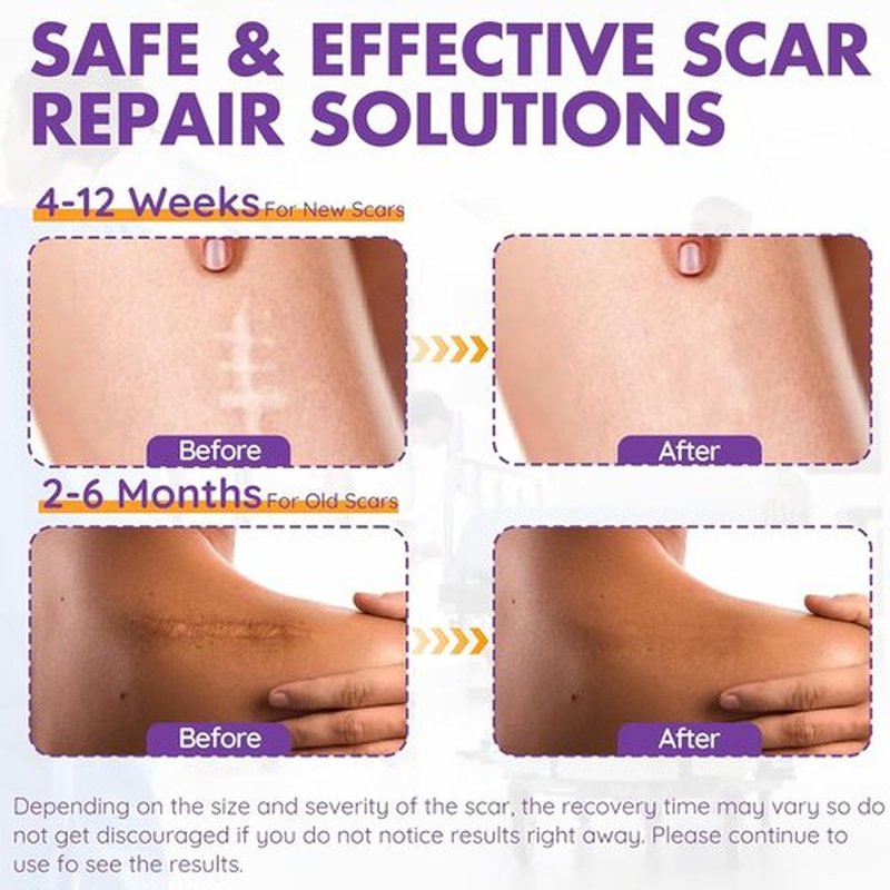 Silicone Scar Sheets, Silicone Scar Tape(1.6"x 118" Roll-3M), Reusable Professional Scar Silicone Strips, Soft Silicone Scar Sheets for Surgical Scars,Keloid,Acne Scars,Burn Scar,C-Section