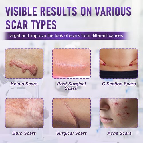Scar Tape for Surgical Scars – Medical Grade Silicone Scar Sheets and Scar Tape for Keloid Removal, C Section Recovery, Tummy Tuck, Burn or Injury Marks, Soft Reusable Silicone Strips (1.6" x 60")