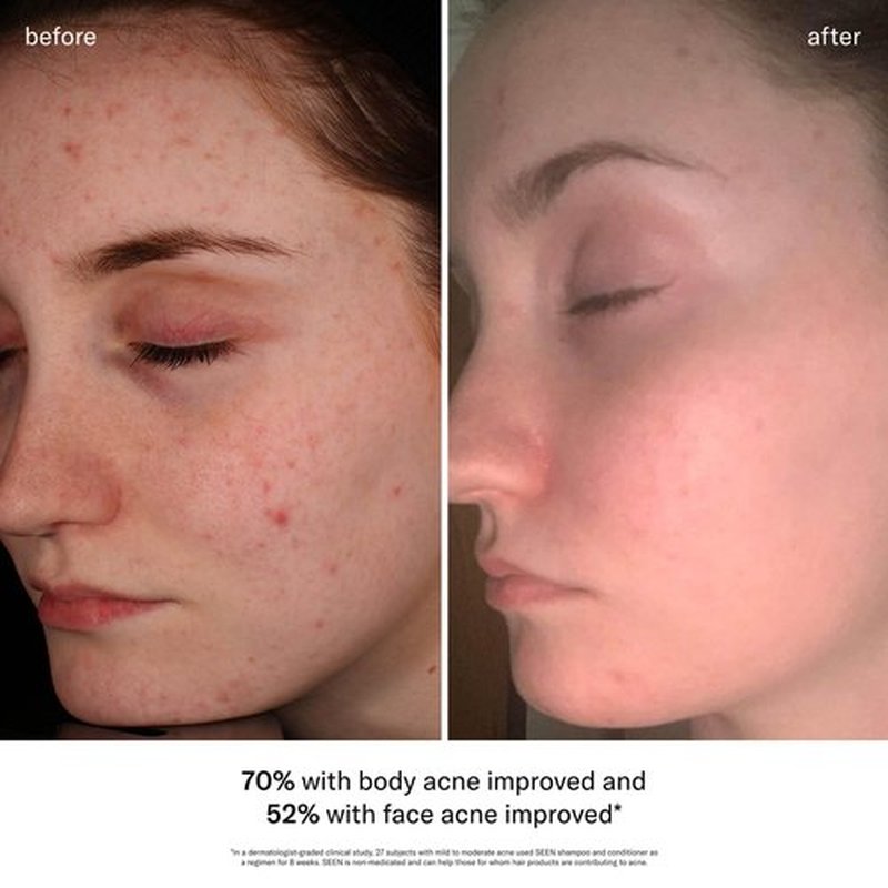 SEEN Acne-Safe Bundle - Scented - Shampoo, Conditioner & Pimple Patches – Non-Comedogenic, Dermatologist-Developed, Safe for Sensitive, Eczema & Acne-Prone Skin