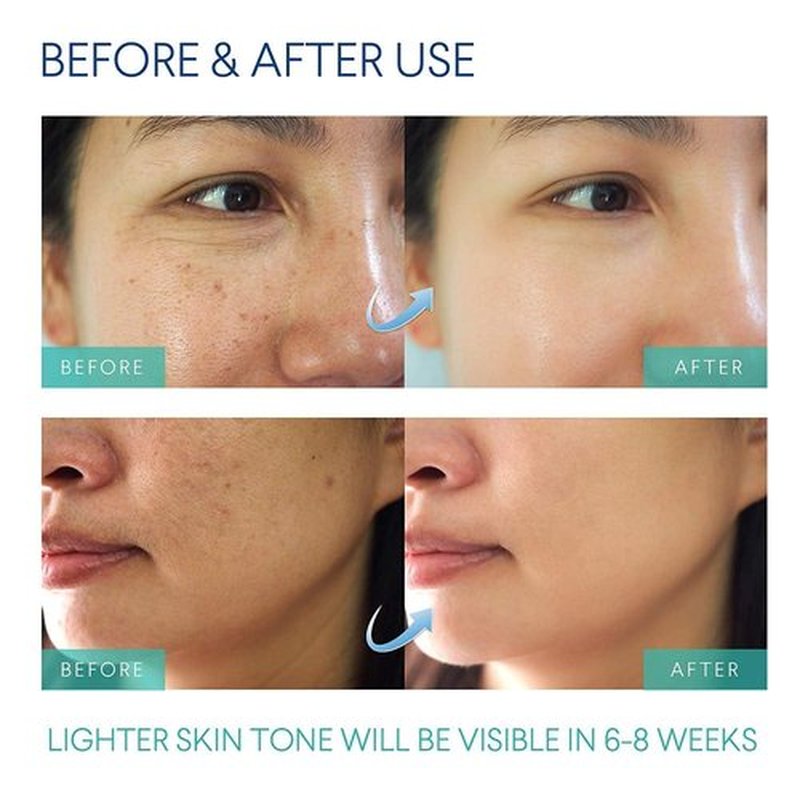 Razor Bumps Treatment for Women and Men, Ingrown Hair Treatment, Razor Bump Treatment for Bikini Area, Face, Neck, Legs, and Underarm Area, After Shave for Women and Men, Ingrown Hair Serum