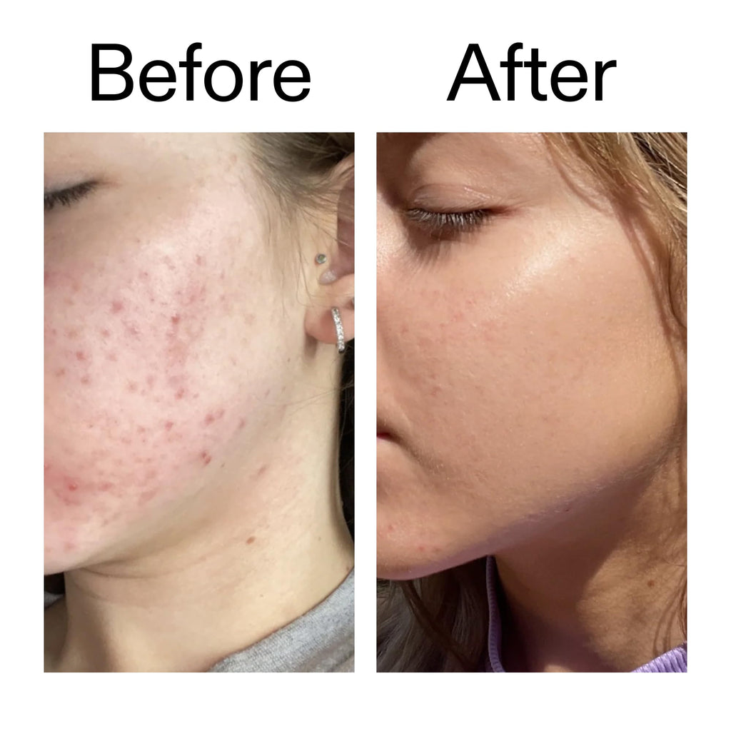 The INKEY List 10% Niacinamide Serum, Lightweight Oil Control Serum Helps with Blemishes and Appearance of Redness, Hydrating 1% Hyaluronic Acid 30ml
