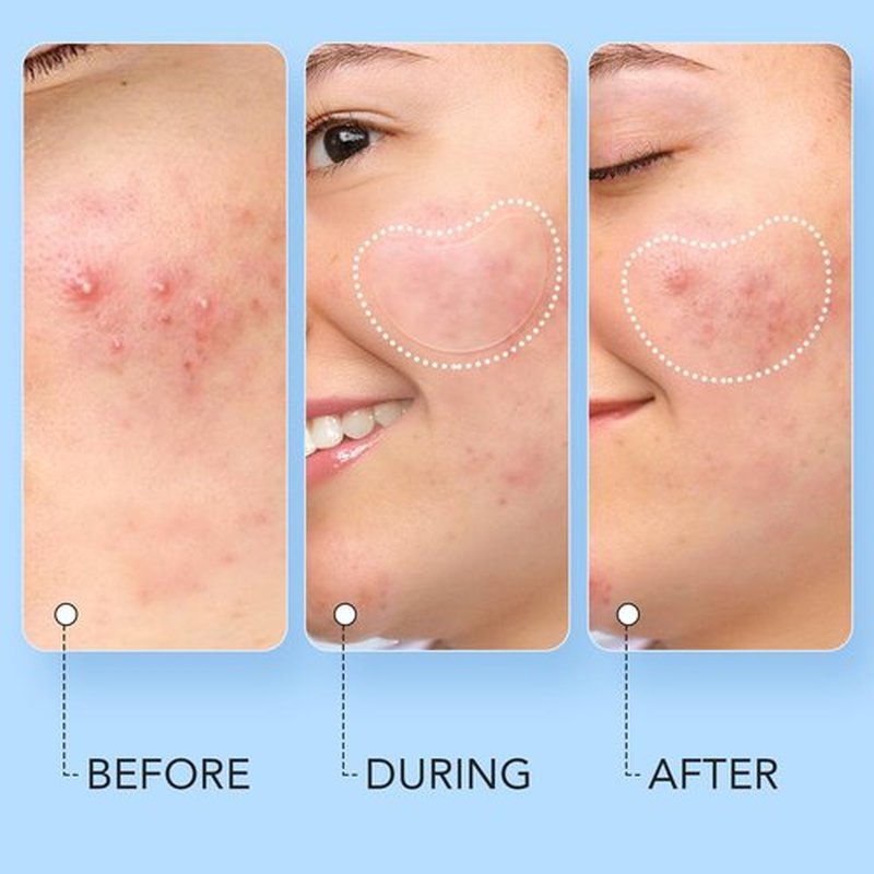 LitBear Acne Pimple Patch, 8 Sizes 140 Pcs Hydrocolloid Acne Patches with Storage Box, 24 XL Pimple Patches for Face, Chin, Nose, 4 Shapes Zits Patches for Blemish, dots with Tea Tree Oil & Cenrella