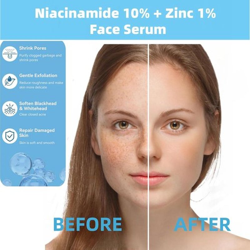 Niacinamide 10% + Zinc 1% Serum - Oil Control & Acne Treatment | Lightweight, Non-Greasy, 30ml
