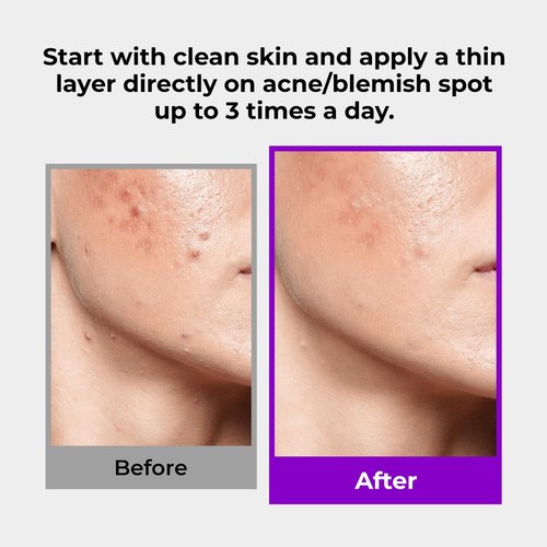 GLAM UP 10% Sulfur Treatment Serum - Fast Healing for Pimples & Acne Breakouts | 15mL (0.5 fl. oz.)