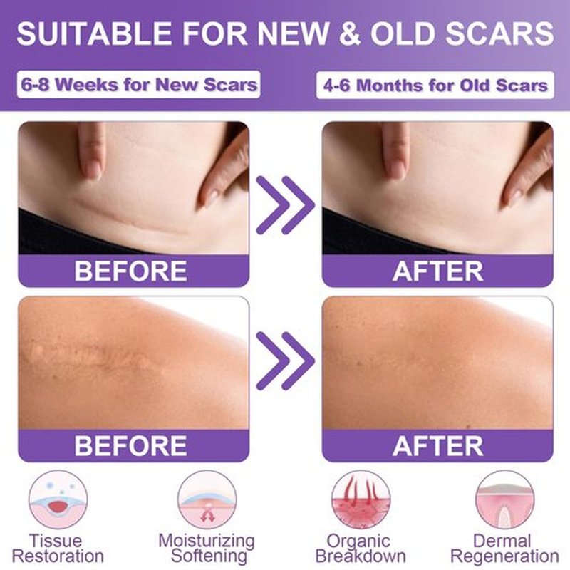 Silicone Scar Sheets, Medical Grade Silicone Scar Tape (1.6" x 60"), Professional Scar Removal Treatment, Reusable, for Healing Keloids, Surgeries Scars, C-sections, and Burns