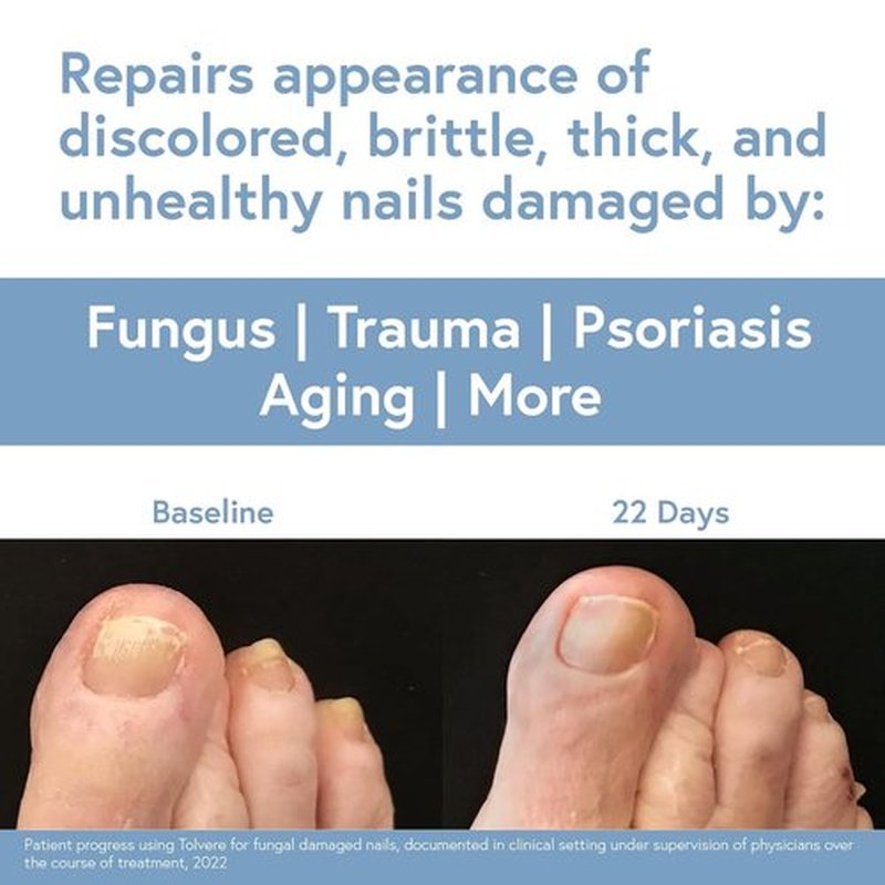 Tolvere Nail Renewal Solution - Restore Discolored, Brittle & Cracked Nails | Fast-Acting Treatment