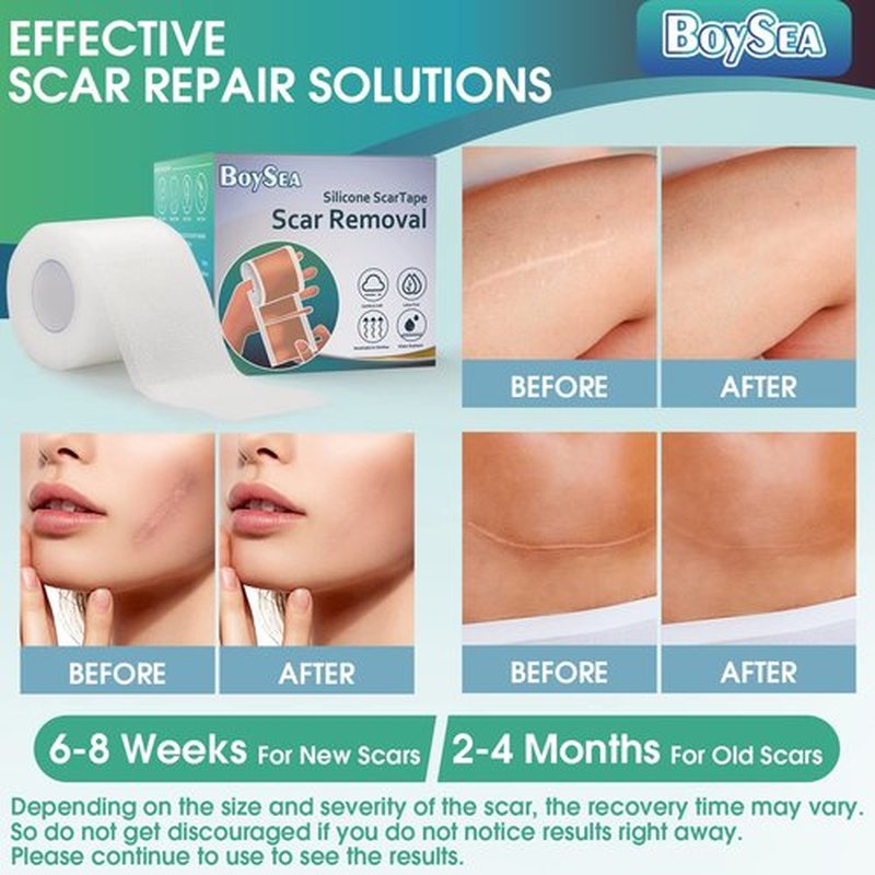 Boysea Silicone Scar Sheets (1.6" x 120") Clear Silicone Scar Tape - Scars Removal Treatment - Reusable Scar Strips for Keloid, C-Section, Burn, Surgical Scars