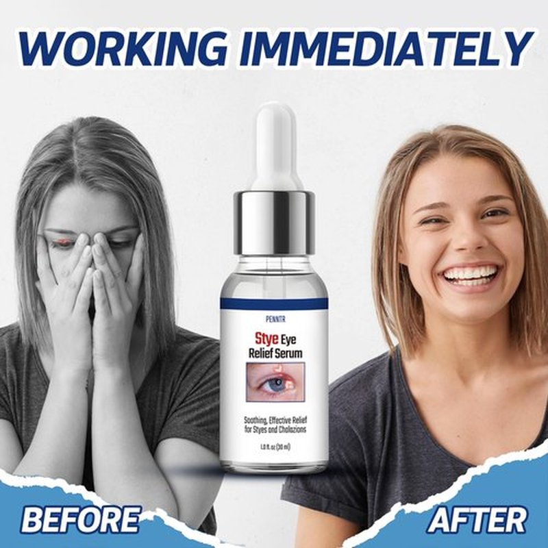 Stye Eye Treatment, Stye Eye Drops, Chalazion Remover, Eye Serum for Styes, Chalazion and Blepharitis Treatment, with Natural Plant-based Formula, 1 Fl Oz