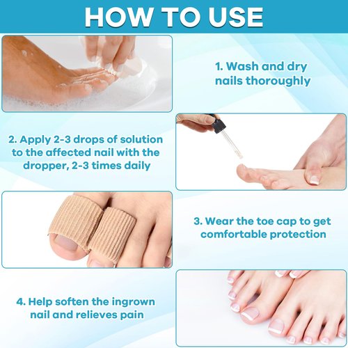 Ingrown Toenail Drop - Ingrown Toenail Pain Reliever and Softener Kit for Men Women Ingrown Toenail Corrector Drops