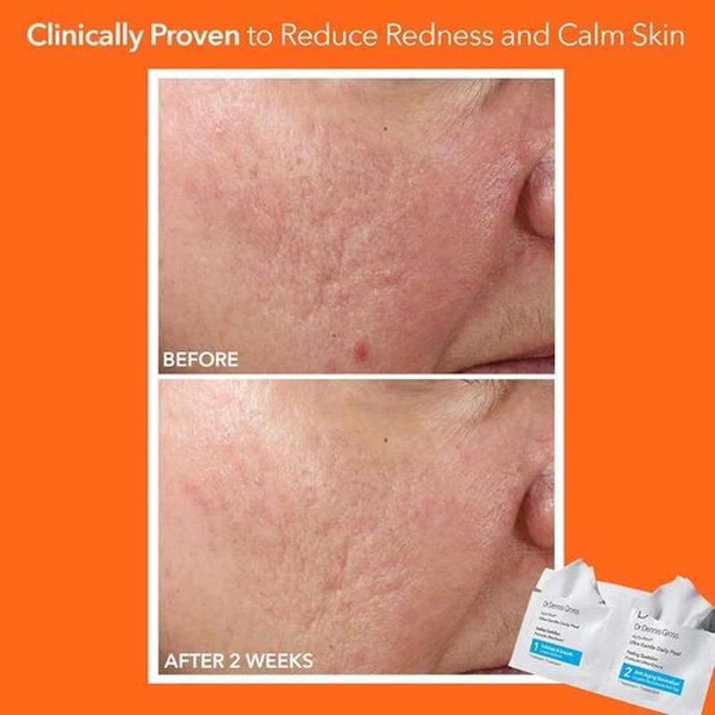 Dr. Dennis Gross Alpha Beta Ultra Gentle Daily Peel - Hydrates Sensitive Skin & Smooths Texture | 30 Treatments