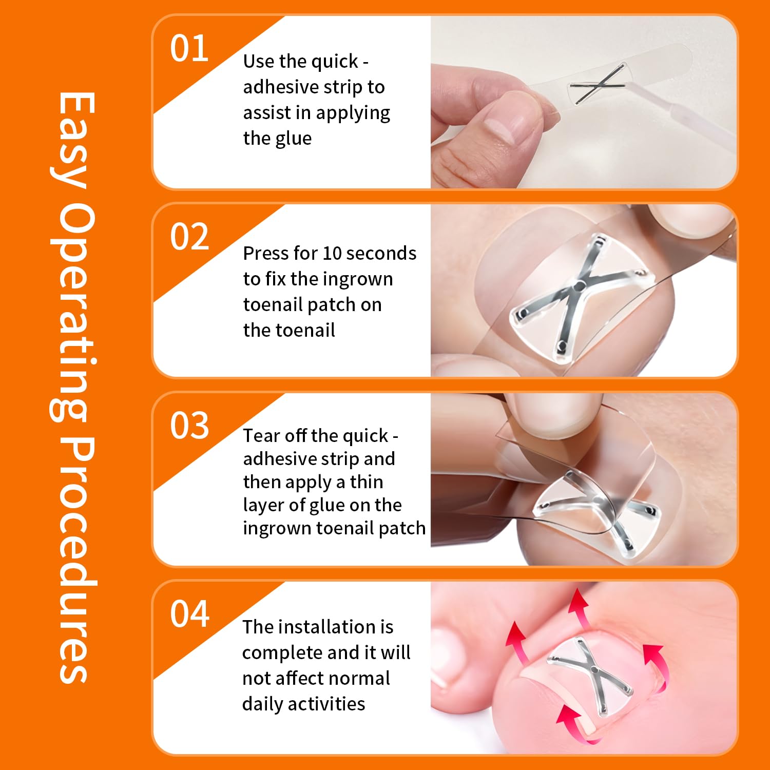 10 Patchs X-Shaped Upgrade Titanium Alloy Ingrown Toenail Corrector,At Home Ingrown Toenail Treatment for Man and Women,Ingrown Toenail Removal Kit,Curved Toenail Corrector (Large Size)