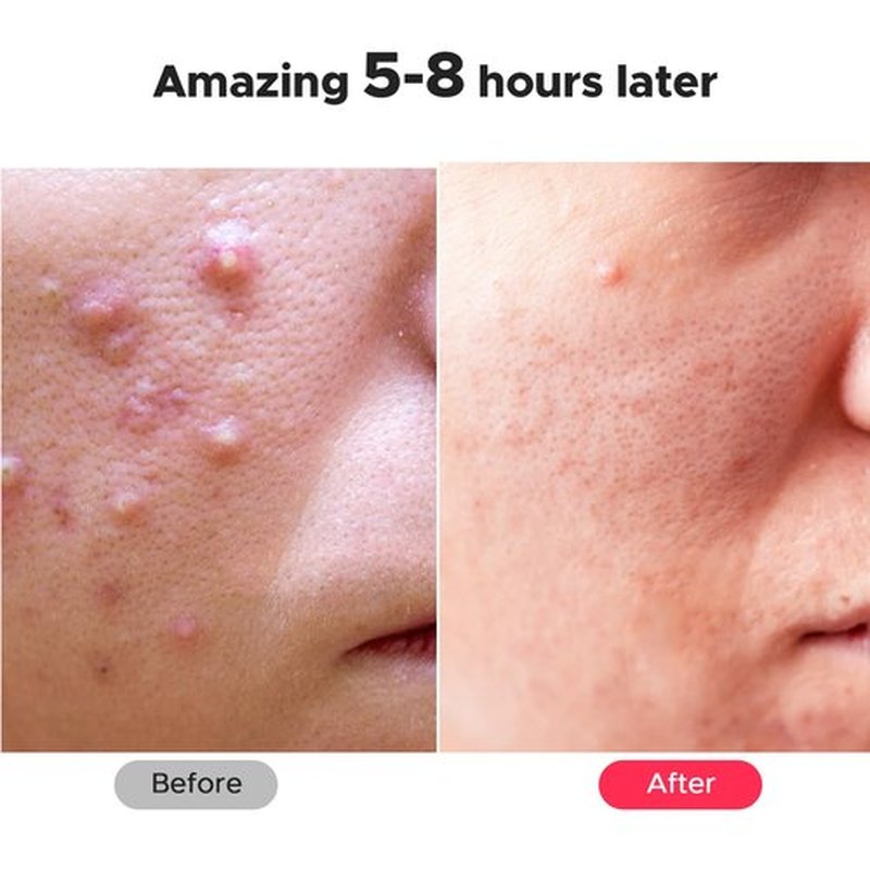 LitBear Large Pimple Patches, 5 Sizes 324 Patches Big Acne Patches, XL Hydrocolloid Bandages for Full Face, Forehead, Chin, Nose, Body, Back, Neck & Chest, Stirp, Square Large hydrocolloid Patch