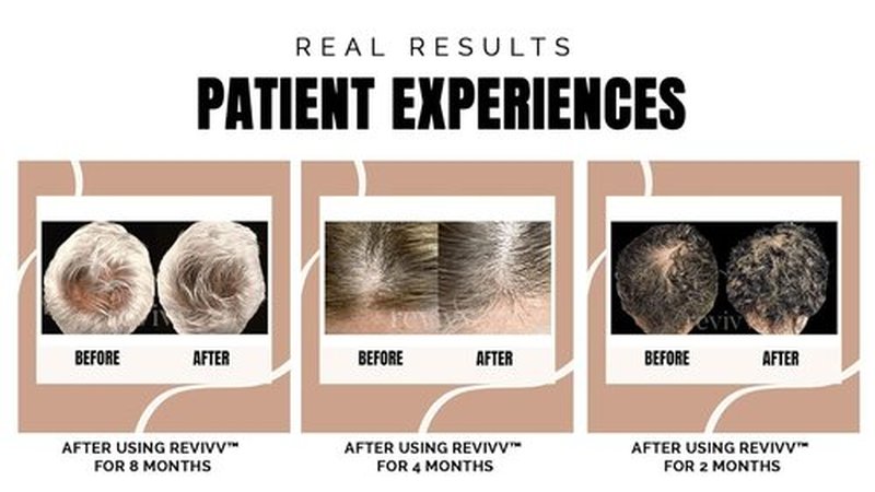 REVIVV Hair Growth Serum - 100% Natural Formula for Thicker, Fuller Hair | 1oz Bottle, 45-Day Supply