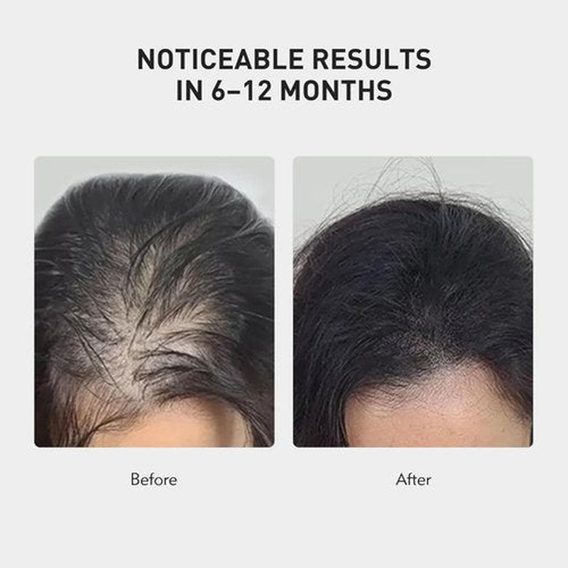KINTOR Hair Regrowth Spray - 0.9% KX-826 Formula for Healthy Hair Growth | Oil Control, 60ml