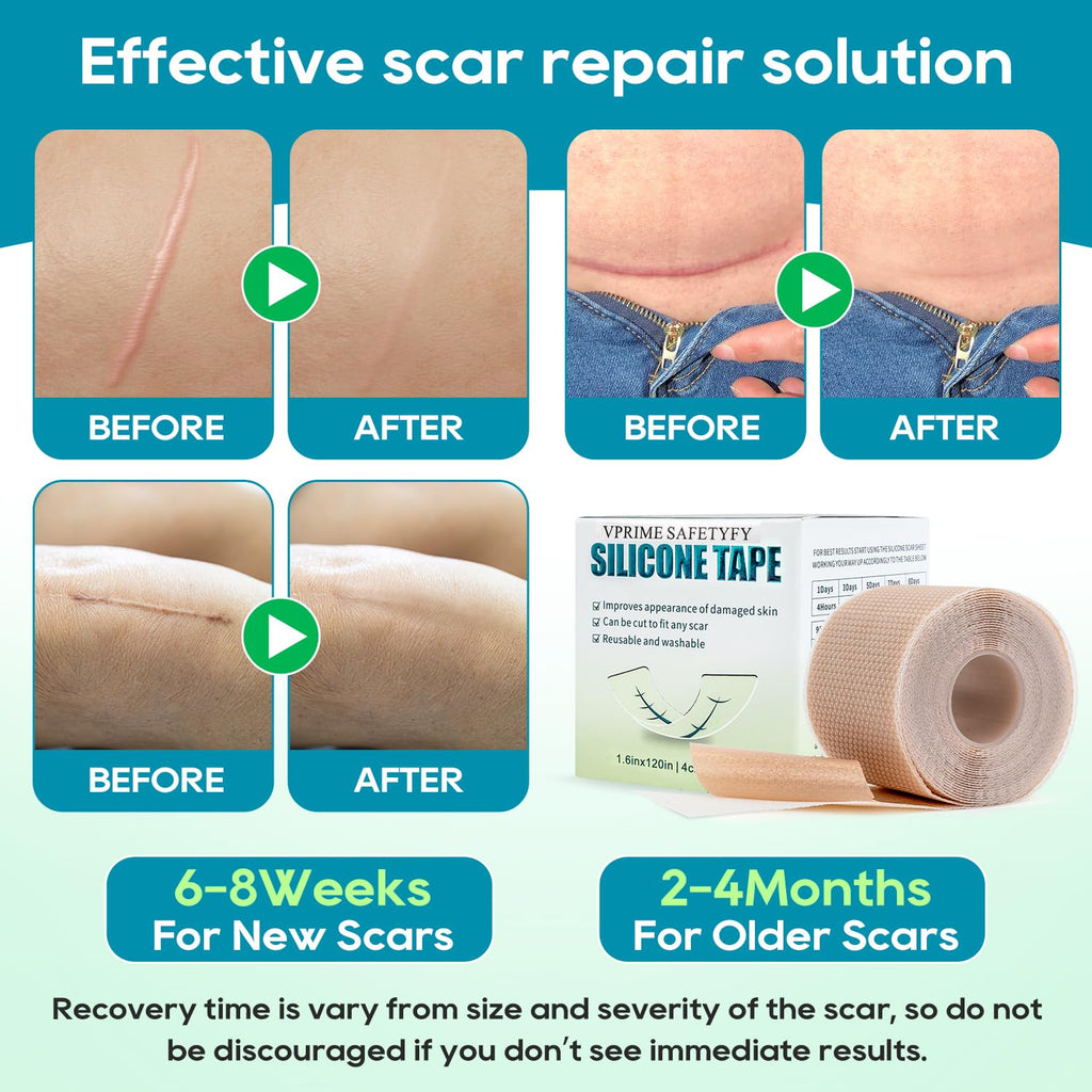VPRIME SAFETYFY Silicone Scar Tape, Silicone Scar Sheets for Surgical Scars (1.6"x 80" Roll-2M), Medical Ggrade Scar Tape for Scars, Keloid, Acne Scars, Burn, C-Section, Stretch Marks Scars Away