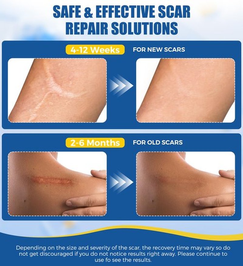 MasterMo Medical Grade Silicone Scar Sheets & Tape - 1.6”x120“ Roll, Ultra Soft, Hypoallergenic Rolls for Surgical, C-Section, Tummy Tuck, Keloid Scars, Stretch Marks & Burn Scar Removal