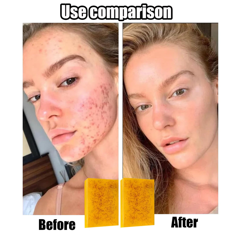 3PCS Lemon Turmeric Kojic Soap + 3 Bubble Nets | Organic Face & Body Bar | Cleansing & Exfoliating | All Skin Types