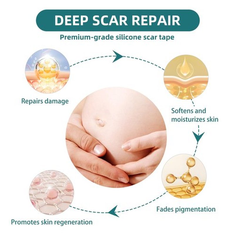 Silicone Scar Gel Sheets: Medical Grade Scar Tape for C Section Surgical Tummy Tuck Keloid Treatment–Scar Removal for Face and Skin