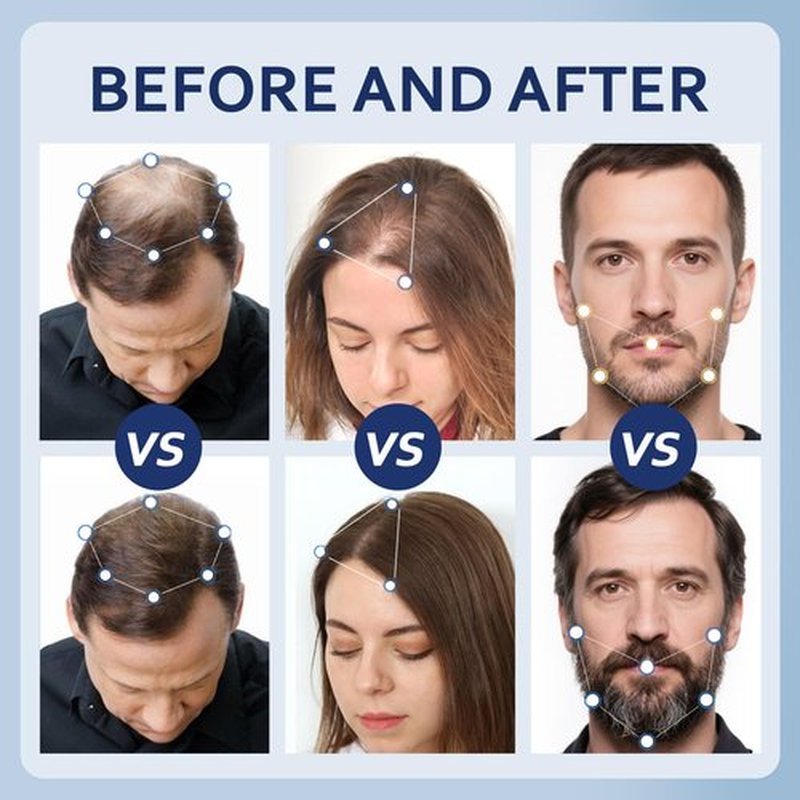 5% Minoxidil Hair Growth Serum for Men & Women with Biotin: Minoxidil for Men and Women, 5 Percent, Hair Regrowth Treatment, Extra Strength (6 FL OZ, Dropper 3pcs)