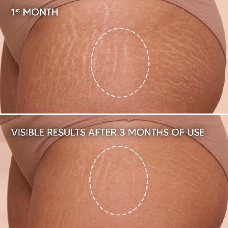Cicatrissim Stretch Mark Cream - Softens & Firms Skin, Evens Tone - For All Skin Types - 150g