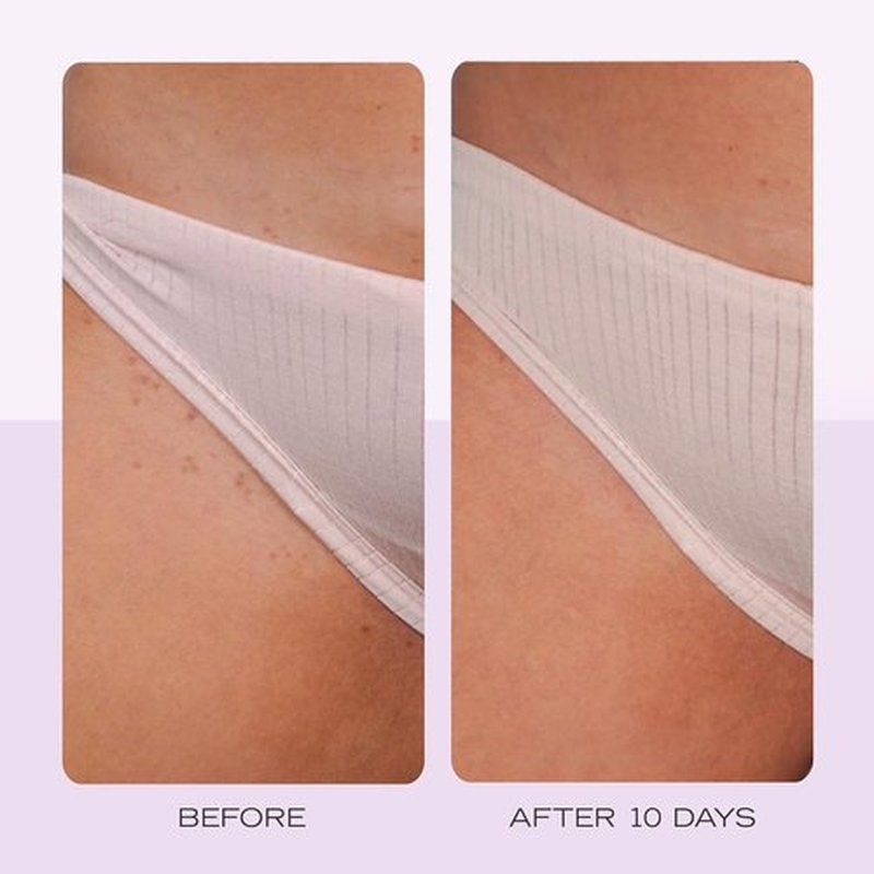 KP Bump Eraser Body Scrub & Ingrown Hair Pads Duo - Exfoliating Treatment for Keratosis Pilaris | 10 oz Scrub, 60 Pads