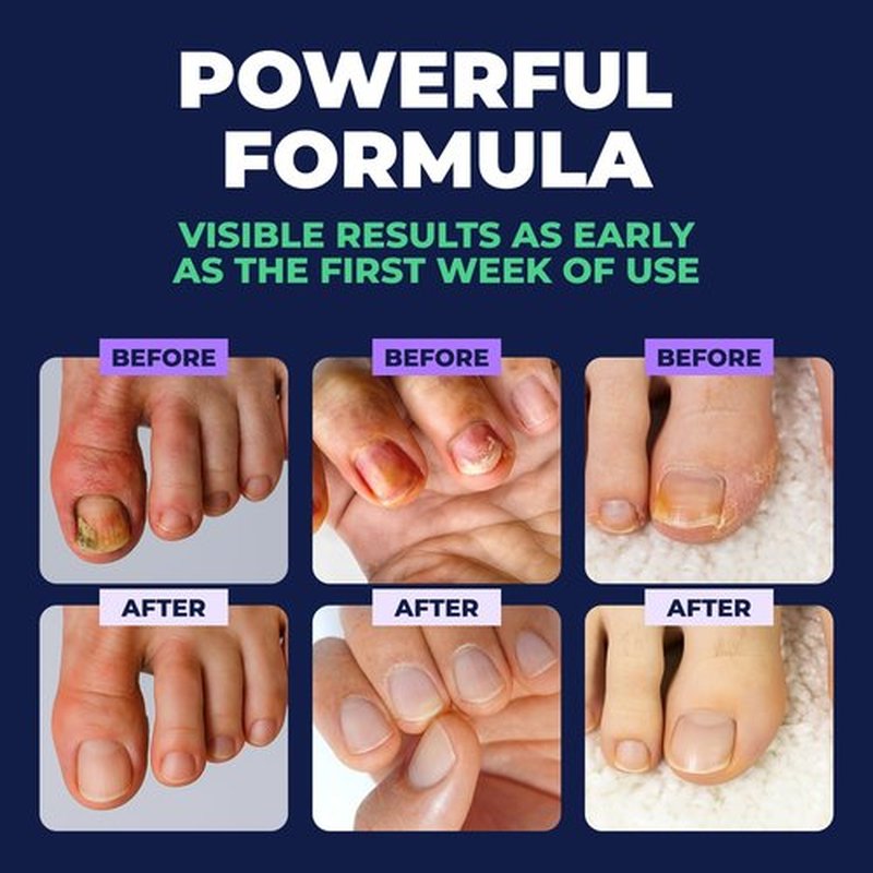 Orivelle Nail Fungus Pen – Professional Nail Repair & Strengthening Solution with Tea Tree Oil – Improves Appearance of Discolored or Damaged Nails (Pack of 2)
