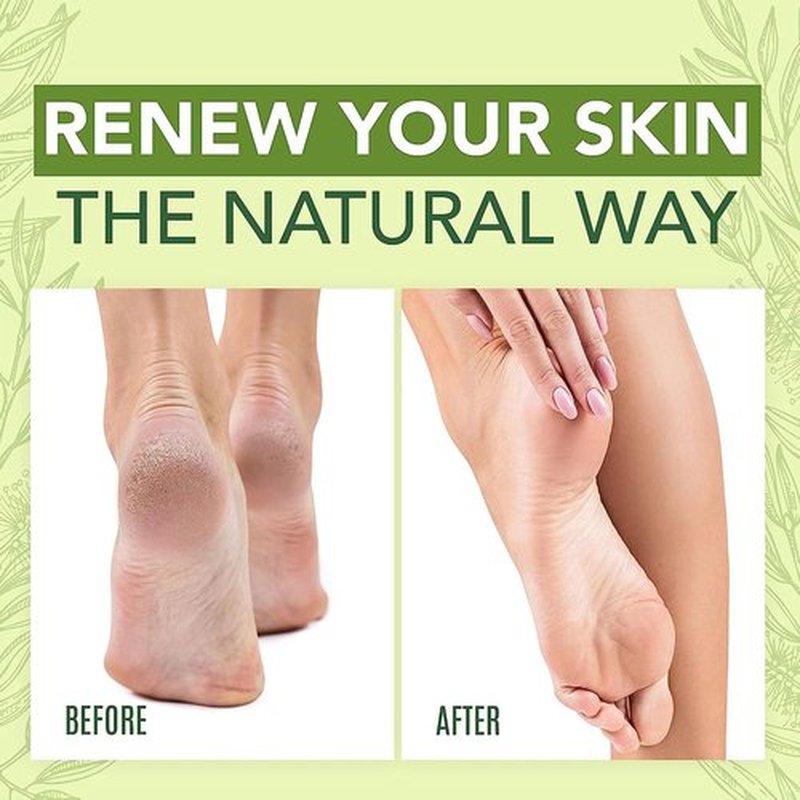 Grospe Tea Tree Foot Cream Repair Foot Athletes Foot Treatment Cream Dead Skin Removal Peeling Moisturizing Exfoliation Foot Care Repair Cream for Dry Cracked Heels,1.7 Fl Oz