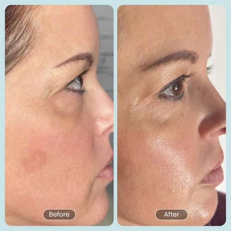 30 Day Miracle BHA 20% Peeling Solution - Clinical Strength Exfoliant for Clogged Pores & Wrinkles | 1oz
