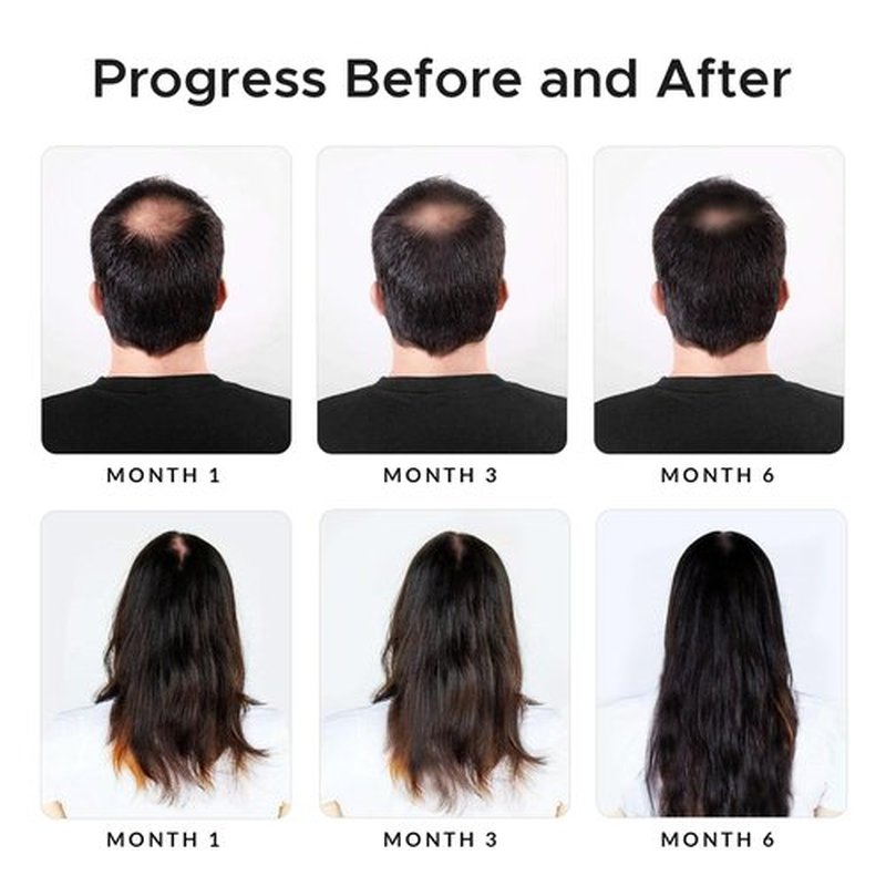 Twopack Thickening Hair Regrowth Shampoo for Thinning Hair - Enriched with Minoxidil, Biotin, Caffeine, Castor Oil & Onion - Supports Hair Growth and Strength for Men & Women - DHT Blocker Formula