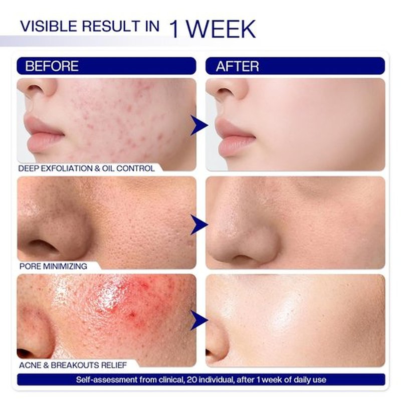 Morovan Glycolic Acid Pads - 30% Dual-Sided Exfoliator for Blemishes | 65 Pads for Clearer Skin