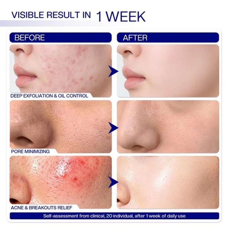 Morovan Glycolic Acid Pads 30%: Dual-Sided Face Exfoliator for Blemishes and Deep Cleaning, Clarifying Skin Tone, At-Home Peel, 65 Pads