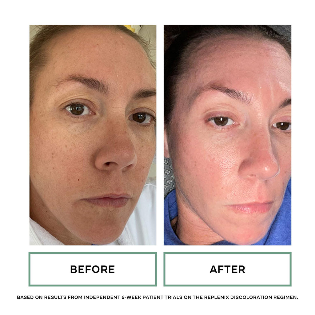 Replenix Discoloration Essentials 3 Step Brightening Medical-Grade Trial Kit (Set Includes Travel-Size Glycolic Acid Resurfacing Cream, Vitamin C Pro Collagen Serum, Brightening Eye Cream)