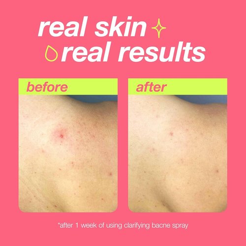 Dermalogica Clear Start Bacne Spray - Effective Back Acne Treatment with Salicylic Acid & Tea Tree Oil | 6 fl oz