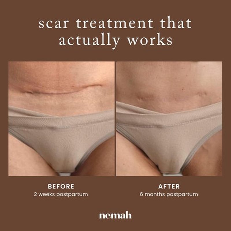 Nemah Restorative Scar Treatment, C Section Recovery, Scar Cream for Surgical Scars, Ideal to Reduce the C Section and Acne Marks, Dermatologist Approved, Antioxidant Rich, Vegan Formula, 1 oz