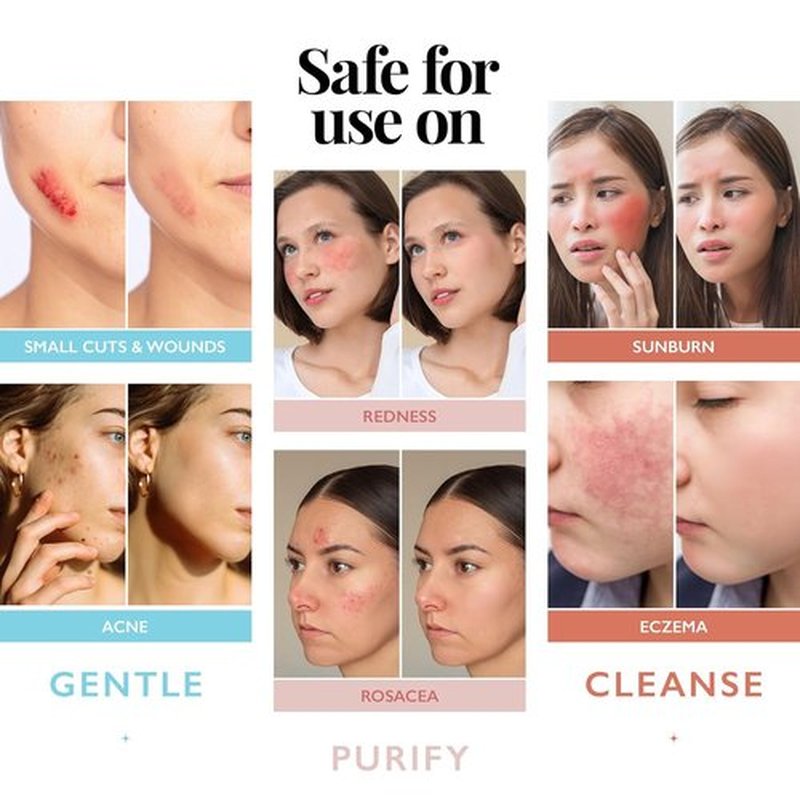 Hypochlorous Acid Spray - Antimicrobial Facial Cleanser for Skin, Acne & Eczema | 8oz Face Mist