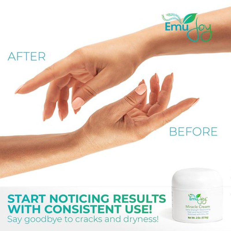 Emu Joy Miracle Cream - Hand & Foot Callus Remover Cream, Intensive Moisturizing Cream for Dry Heels and Soles, No More Foot Scrubbers & Files, Get Professional Salon Pedicure At Home (2 oz.)