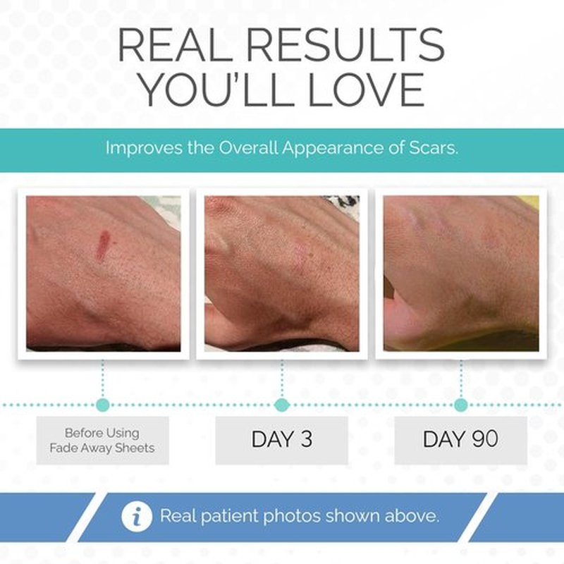Clinically Proven Silicone Scar Sheets – Medical Grade Tape for Surgery, C-Section, Keloids & Tummy Tuck Scars