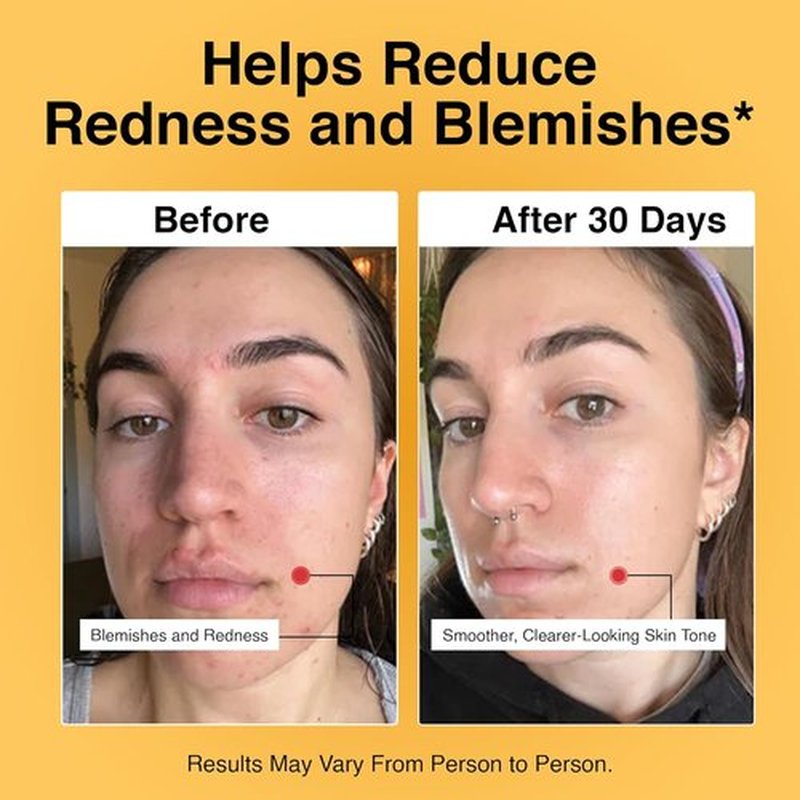 Foundation Skincare Azelaic Acid Face Treatment 14% - Dermatologist-Approved for Blemish-Prone Skin, Smooth Texture & Even Tone (1 Fl Oz)