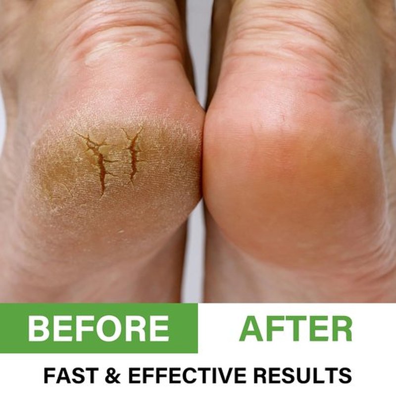AOPEIBOTO Urea Cream 60 Percent for Feet Maximum Strength, Foot Cream for Dry Cracked Heels and Feet, Foot Moisturizer, 5.29oz/150g