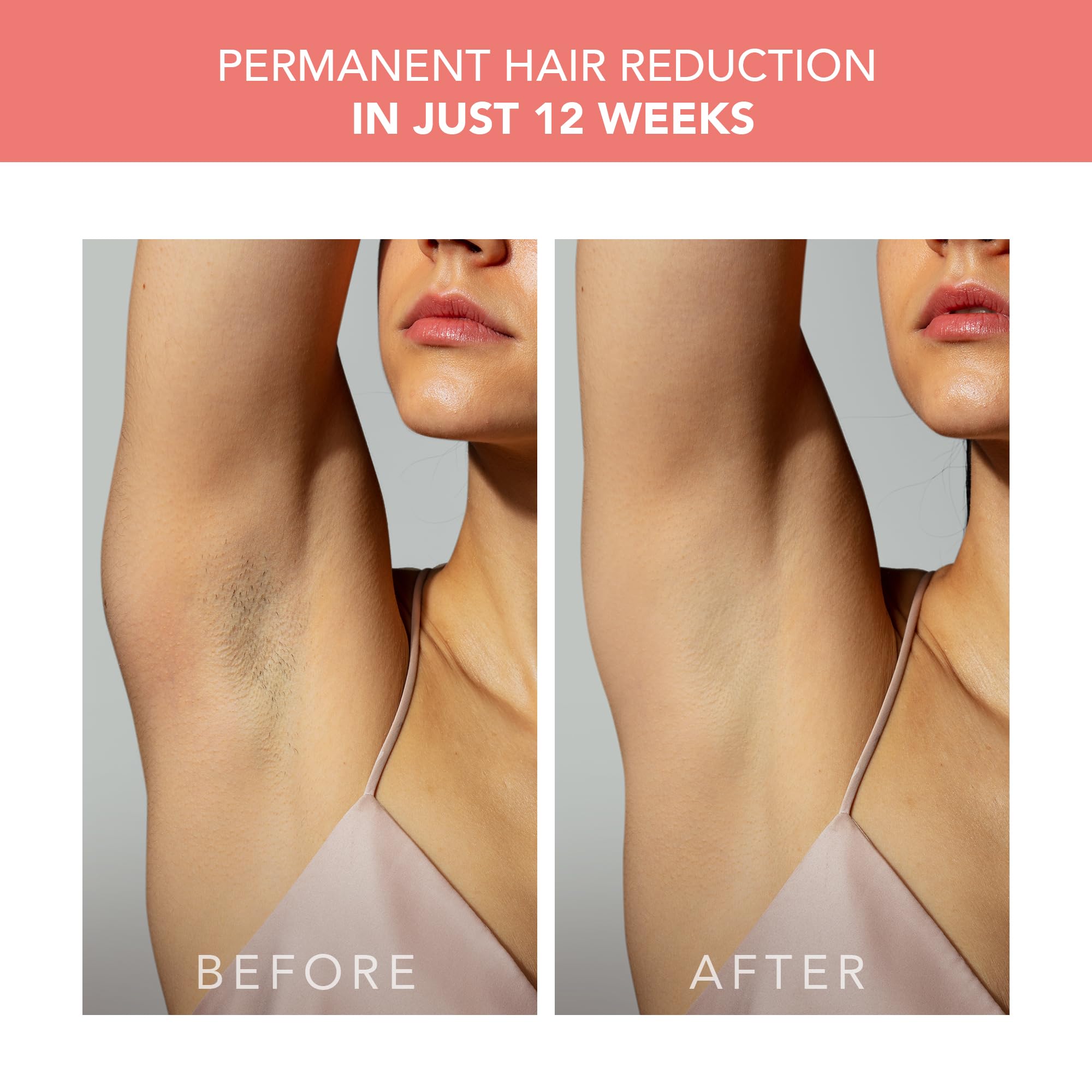FOREO Peach 2 IPL Hair Removal Device – Quick & Gentle Hair Reduction – for Full Body & Face – Skin Cooling System – Silicone Shield - Coral